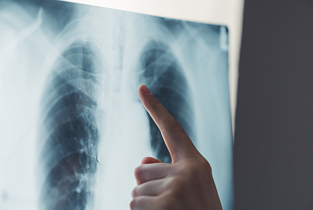 Screeningy rakoviny využívá jen 60 procent lidí. Nová kampaň cílí na prevenci
