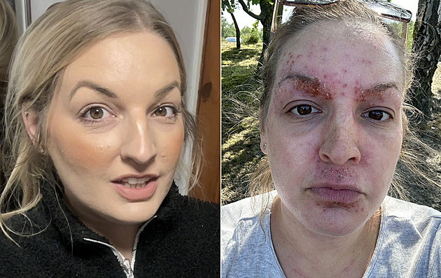 Kvůli masti od dermatologa žena zažívá denně obrovská muka