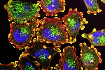 V klinické studii uspěla první vakcína proti melanomu